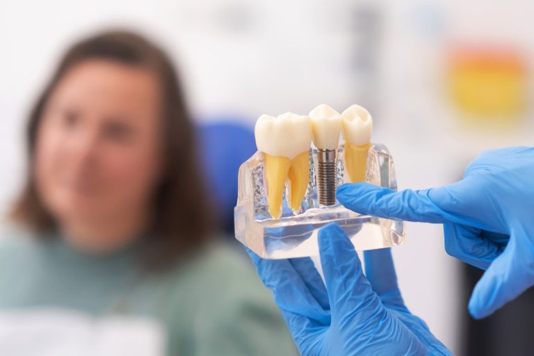 Dental Implants
