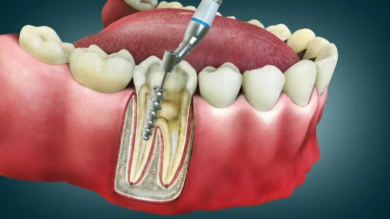 Root Canal Treatment (RCT)